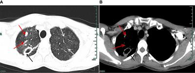 Case report: Application of morphology in the diagnosis of siderosis in a patient with tuberculosis infection